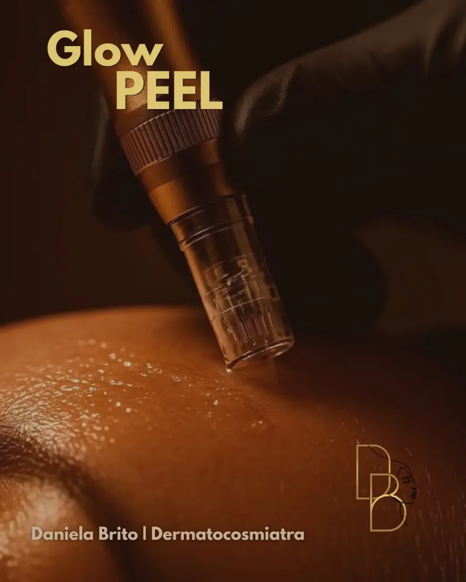 Julio | Glow Peel Limpieza Facial Profunda + Microneedling con Hialuronico 30% OFF