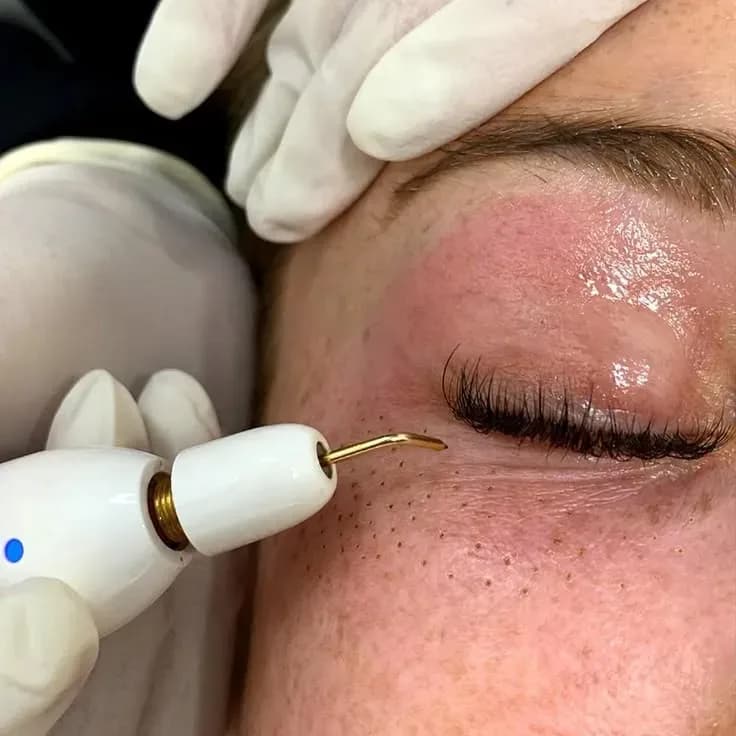 Fibroblast Facial y Corporal